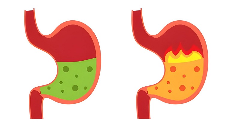Best Acidity Treatment in Mumbai